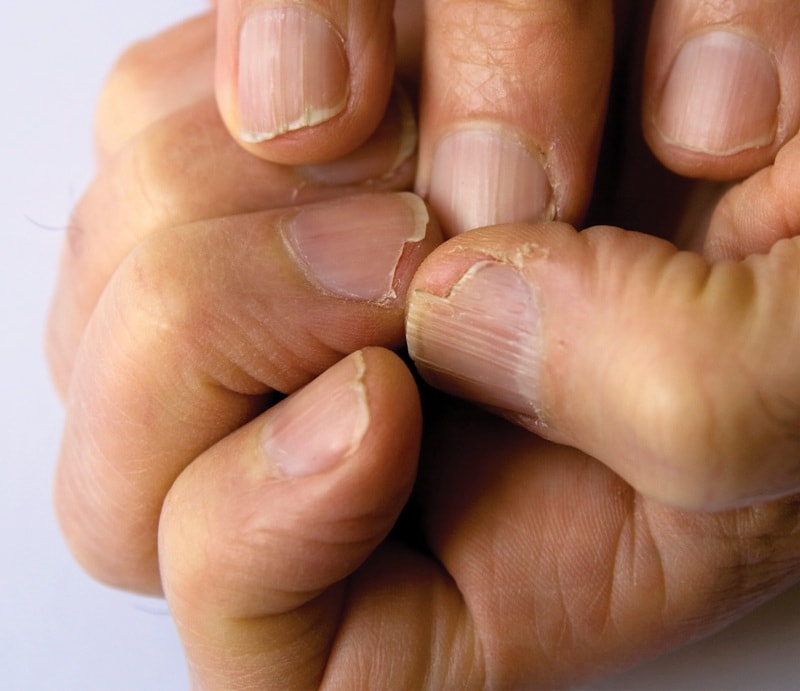 Расслоение ногтей