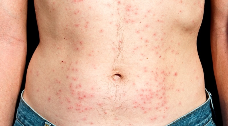 Сыпь на теле при приеме Микозорала