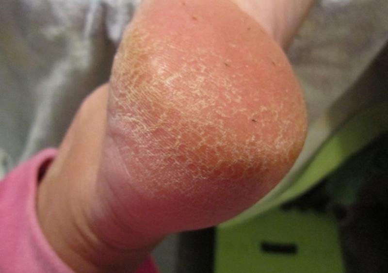 Трещины на пятках