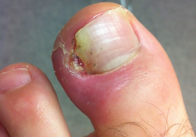 Вросший ноготь