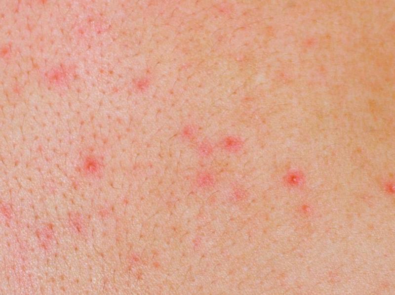 Высыпание на коже