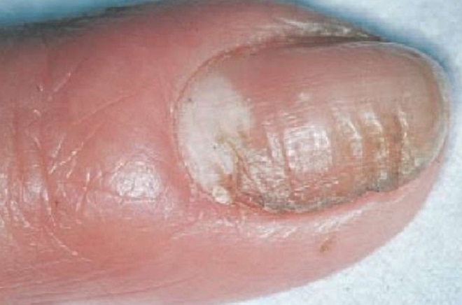 дрожжевой грибок ногтей дрожжевой грибок