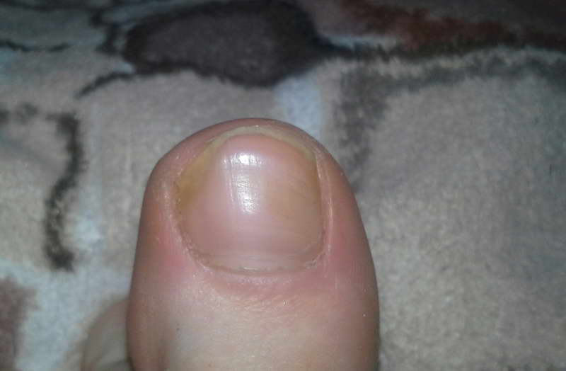 масло чайного дерева применение