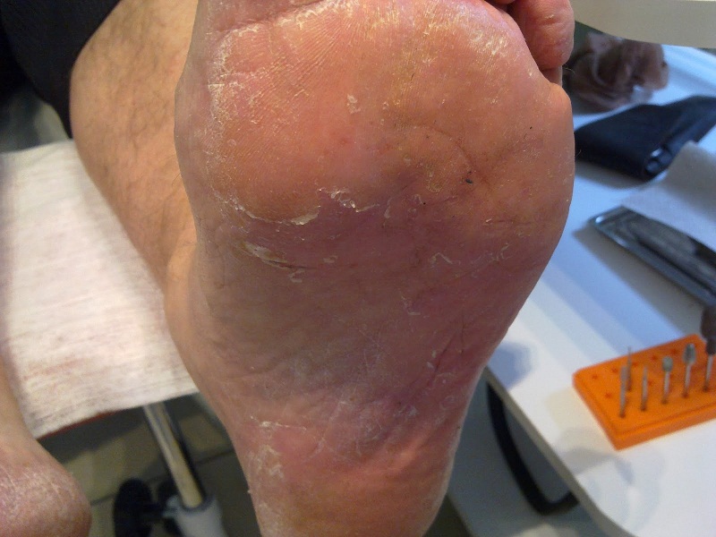 Микоз стопы