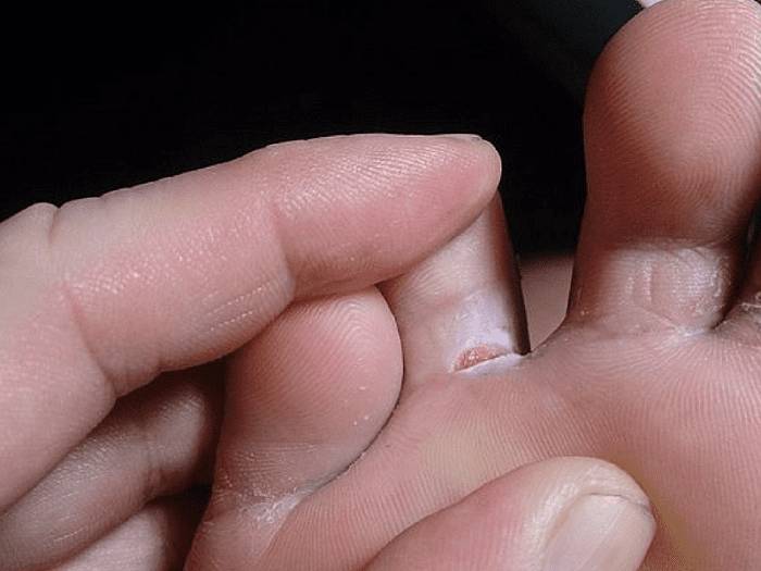 Трещины между пальцев