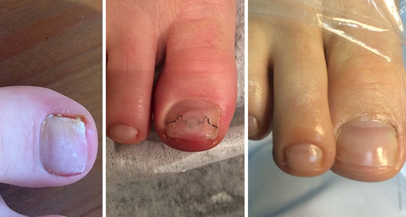 Грибок ногтя на большом пальце ноги
