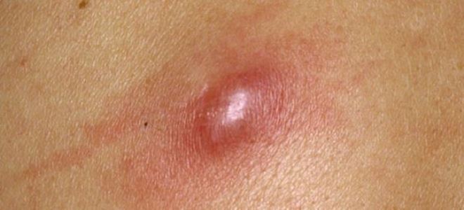 большие прыщи на теле