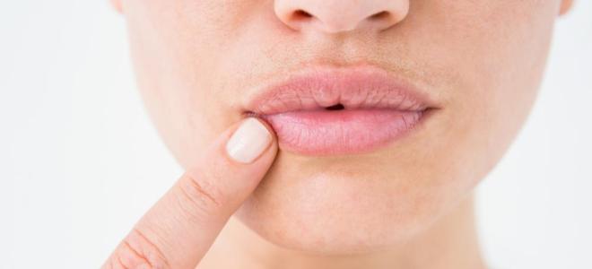 Экзематозный хейлит