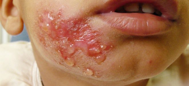 Буллезное импетиго у детей раз Буллезное импетиго у детей раз