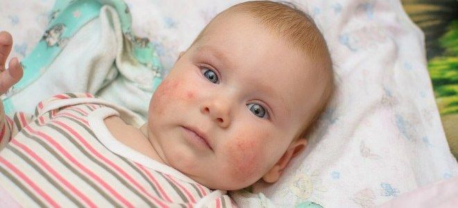 Аллергический дерматит причины Аллергический дерматит причины