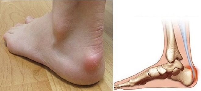 болезнь хаглунда шинца болезнь хаглунда шинца