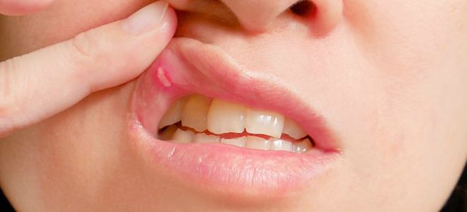 что помогает от стоматита что помогает от стоматита