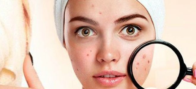 что помогает от угревой сыпи что помогает от угревой сыпи