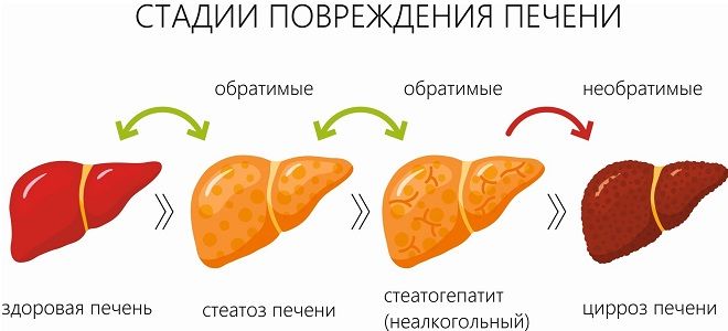 фото1 цирроз печени на узи