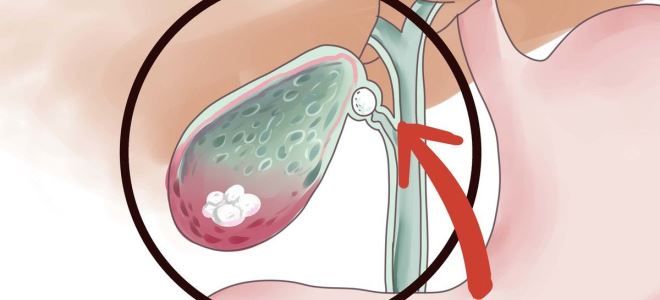 холестериновый полип в желчном пузыре холестериновый полип в желчном пузыре