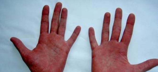 истинная полицитемия истинная полицитемия