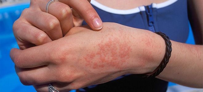 как выглядит аллергия на яйца как выглядит аллергия на яйца