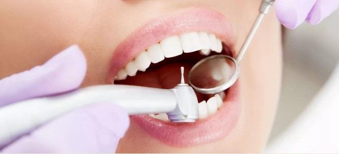 какие бывают стоматологические пломбы какие бывают стоматологические пломбы