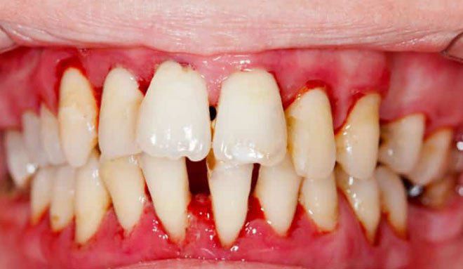 катаральный гингивит у детей катаральный гингивит у детей