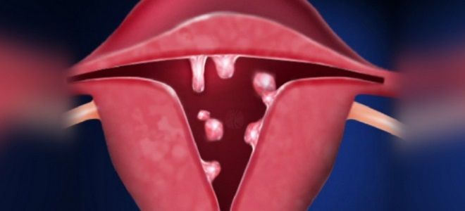 когда удалять полип в матке когда удалять полип в матке