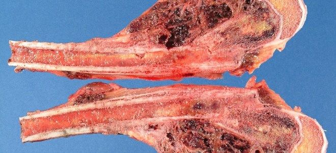 лечить рак кости лечить рак кости