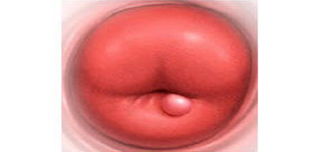 лейкоплакия шейки матки что это лейкоплакия шейки матки что это