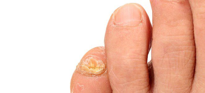 микоз ногтей на ногах микоз ногтей на ногах