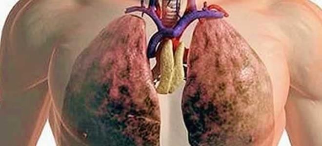 муковисцидоз легких муковисцидоз легких