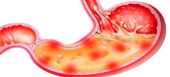 острый гастрит острый гастрит