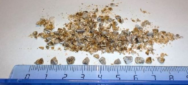 песок в почках симптомы песок в почках симптомы