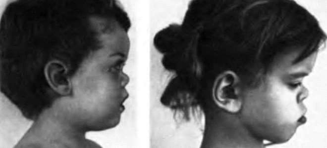 pfapa синдром pfapa синдром