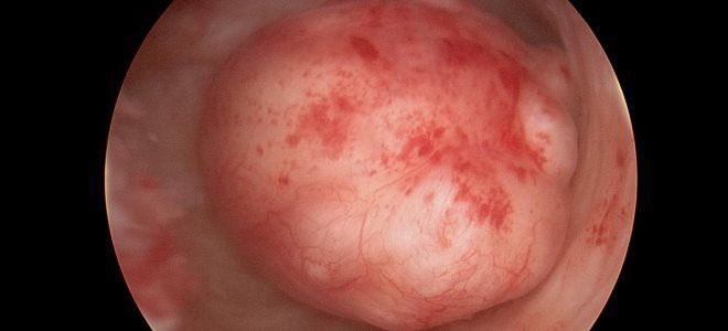 почему возникает миома почему возникает миома