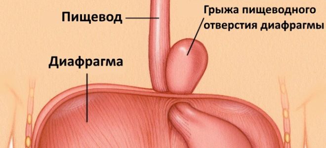 причины грыжи пищеводного отверстия диафрагмы причины грыжи пищеводного отверстия диафрагмы