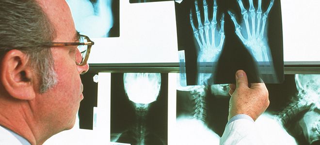 ревматоидный артрит ревматоидный артрит