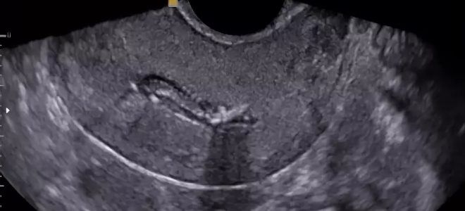 сгустки в матке сгустки в матке