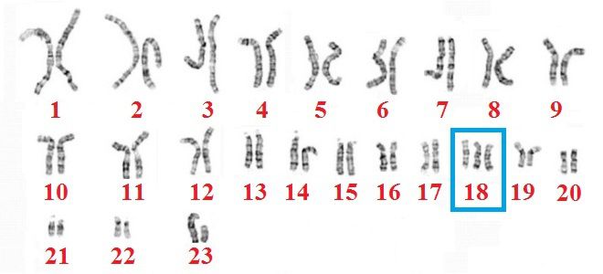 Синдром Эдвардса генетика Синдром Эдвардса генетика