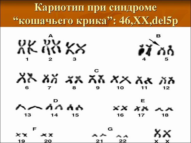 синдром лежена синдром лежена