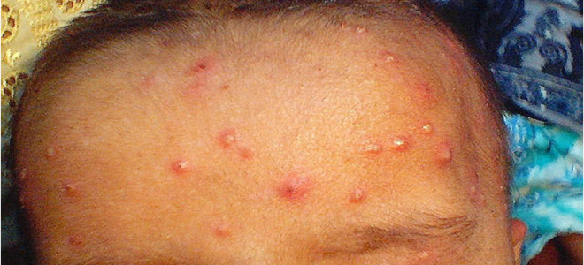 Стафилококковое импетиго раз Стафилококковое импетиго раз