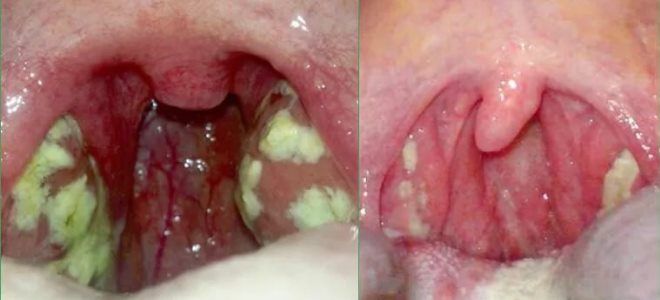 тонзиллит пробки тонзиллит пробки