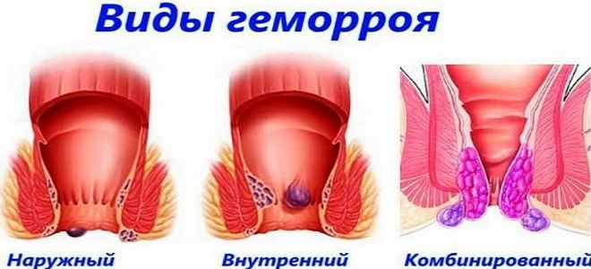 виды геморроя виды геморроя