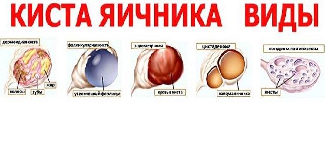 виды кист яичника виды кист яичника