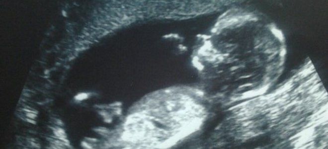 живот на 13 неделе живот на 13 неделе