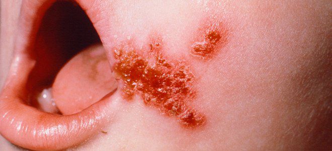 Щелевидное импетиго у детей раз Щелевидное импетиго у детей раз