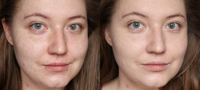 bb glow treatment bb glow treatment