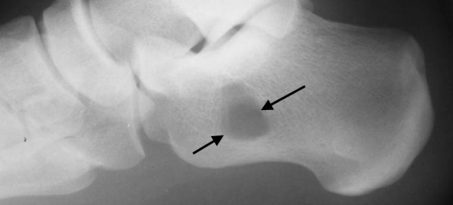 болезнь пятки шинца болезнь пятки шинца