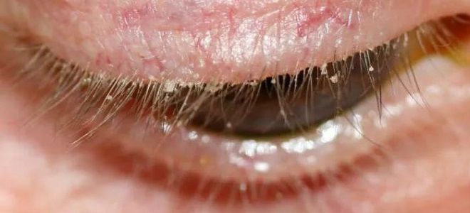 демодекоз у человека демодекоз у человека