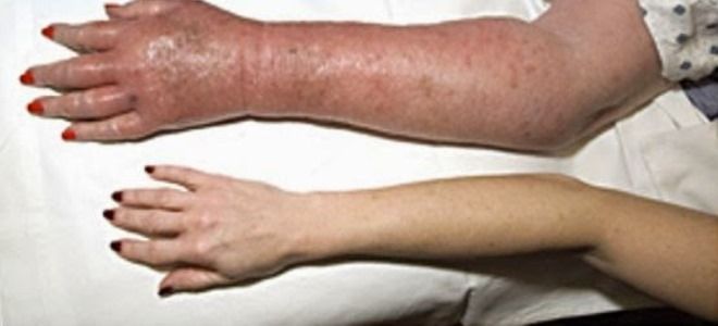 эритремия вакеза эритремия вакеза