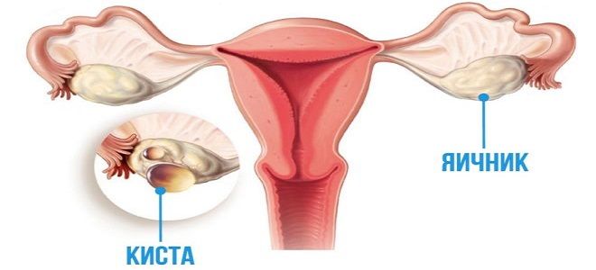 фолликулярная киста яичника фолликулярная киста яичника