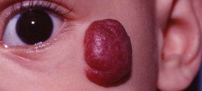 Гемангиома признаки простая Гемангиома признаки простая