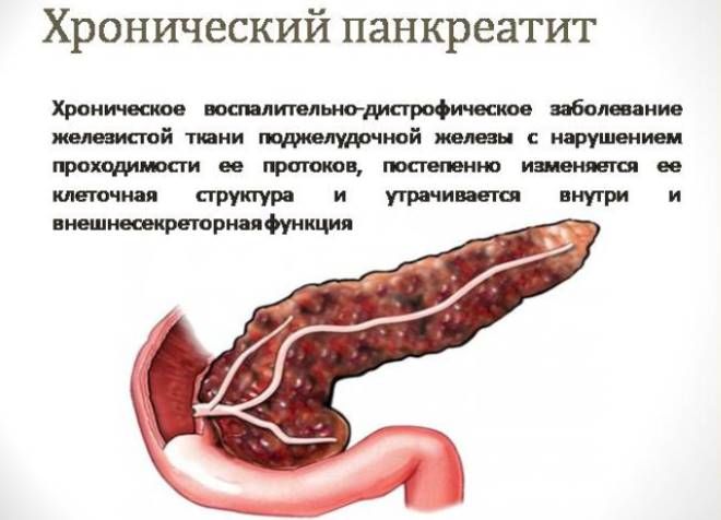хронический панкреатит хронический панкреатит